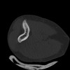 SPORK, NICO - 22.03.1976 - 02.08.2022 - CT obere Extremität - 17:51:17